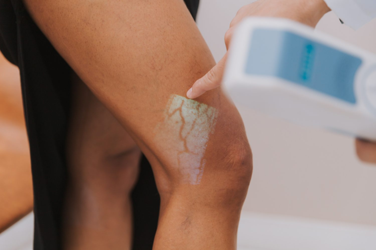 Mapeamento das veias com transiluminação durante a avaliação vascular